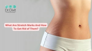 What Are Stretch Marks And How To Get Rid of Them?