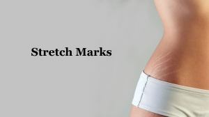 Stretch Marks After Pregnancy: 4 Tips For Removing Them?