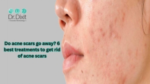 Do acne scars go away? 6 best treatments to get rid of acne scars